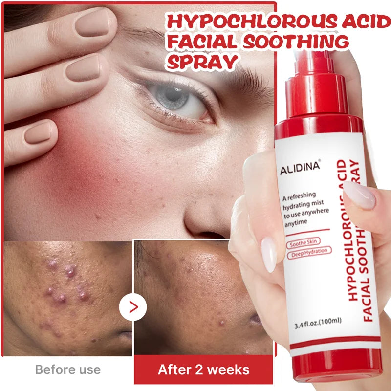 R Hypochlorous Acid Power Soothing Spray Delicate Skin Daily Solution & Post-Sun Care HOCI Facial Mist for Soothing & Calming