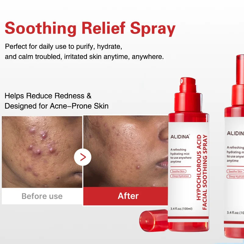 R Hypochlorous Acid Power Soothing Spray Delicate Skin Daily Solution & Post-Sun Care HOCI Facial Mist for Soothing & Calming