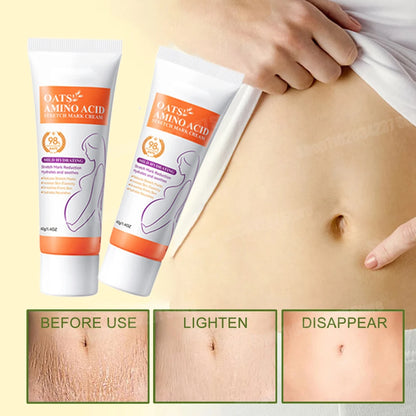 Stretch Marks Removal Cream Light Lines Postpartum Obesity Pregnancy Powerful Fast Absorption
