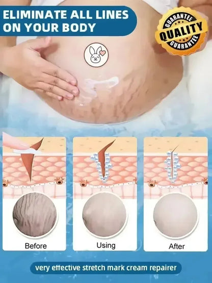Eliminate Red White Old Stretch Marks Cream For Pregnancy Postpartum Skin Care