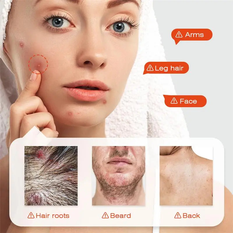 Body Acne Removal Cream Treatment Face Butt Back Acne Marks Smooth Repair Chicken Skin Cream Moisturizing Whitening Skin Care