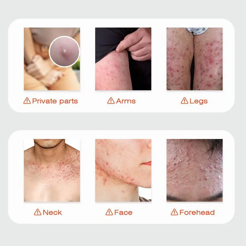 Body Acne Removal Cream Treatment Face Butt Back Acne Marks Smooth Repair Chicken Skin Cream Moisturizing Whitening Skin Care