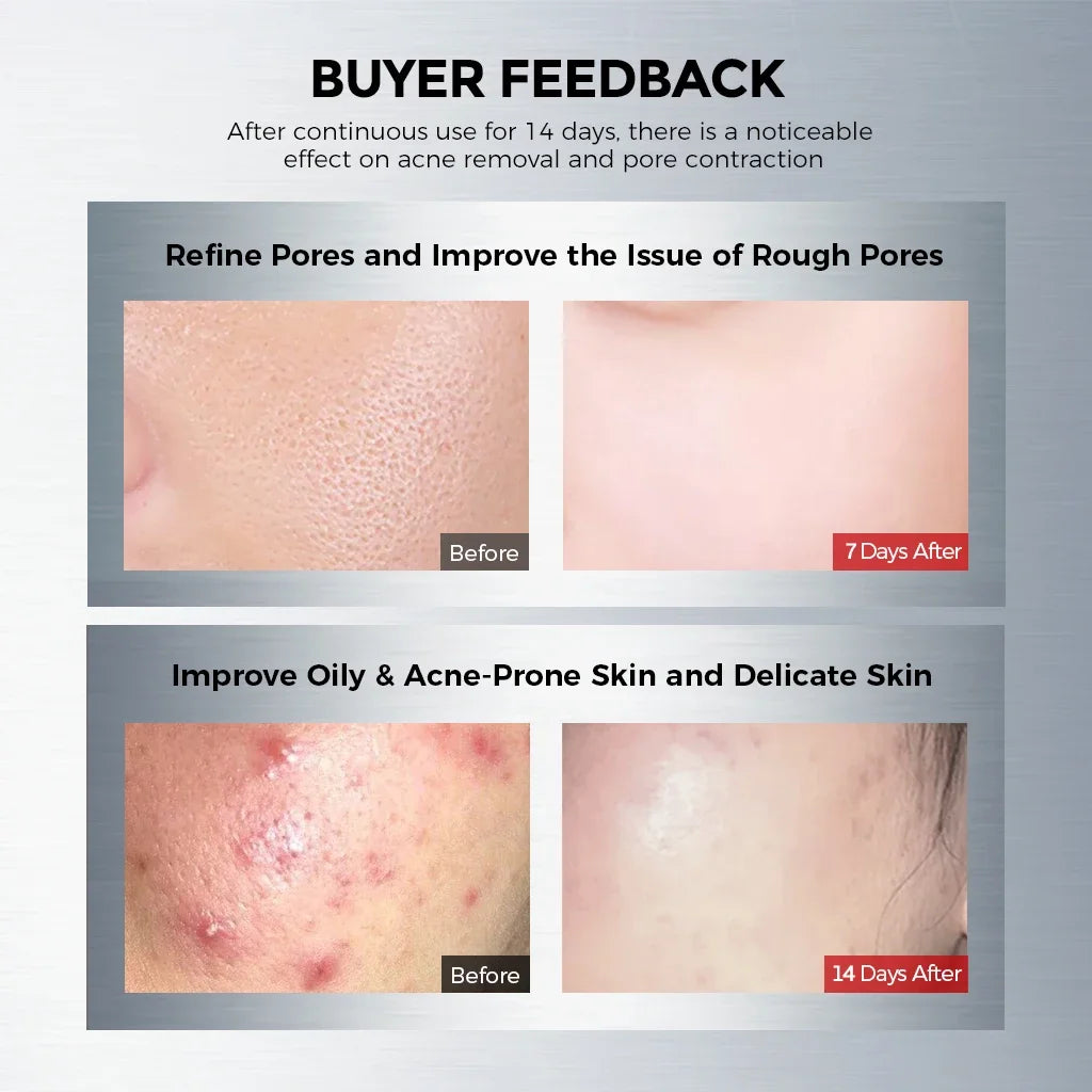 Salicylic Acid 2% Face Serum: Niacinamide + Centella Extract, Aids Blemish Soothing, Pore Refining & Oil Regulation