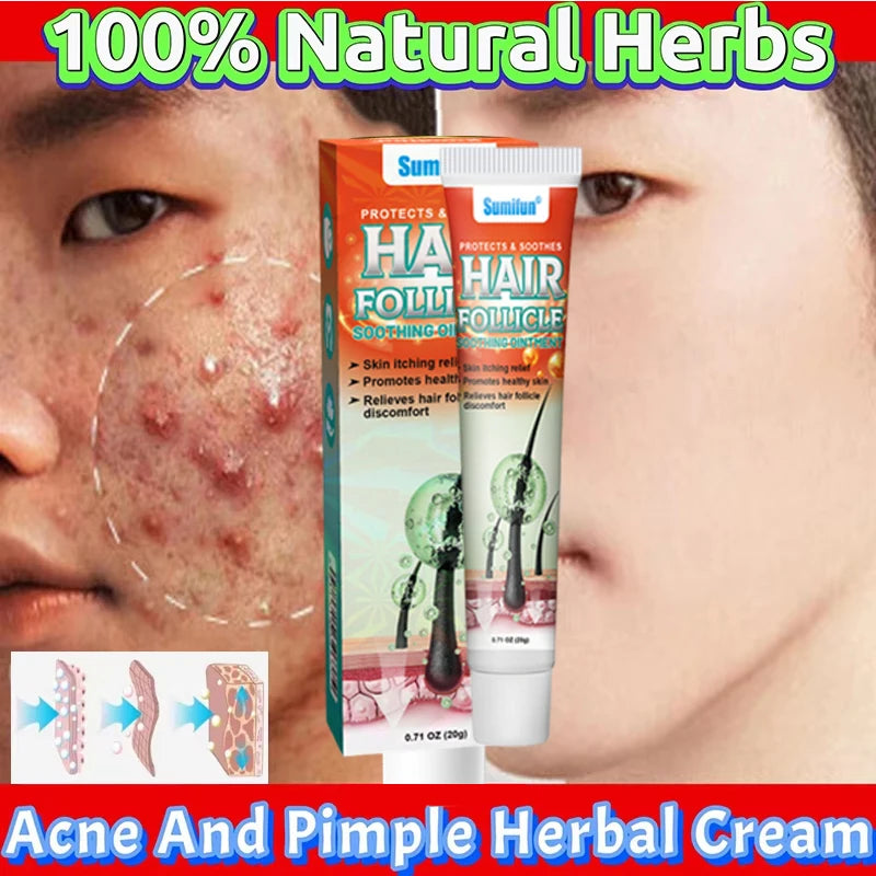 Body Acne Removal Cream Treatment Face Butt Back Acne Marks Smooth Repair Chicken Skin Cream Moisturizing Whitening Skin Care