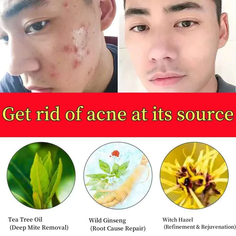 Salicylic Acid Acne Treatment Cream Shrink Pore Remove Blackheads Scars Acne Marks Spots Oil Control Whitening Korean Skin Care