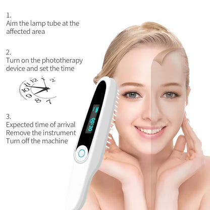 311nm UVB Phototherapy Lamp Recommended by Dermatologists for Skin Treatment