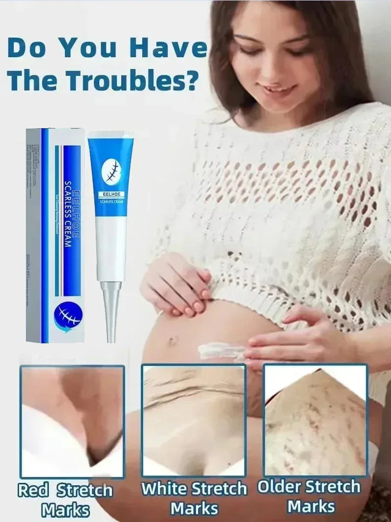 Eliminate Red White Old Stretch Marks Cream For Pregnancy Postpartum Skin Care