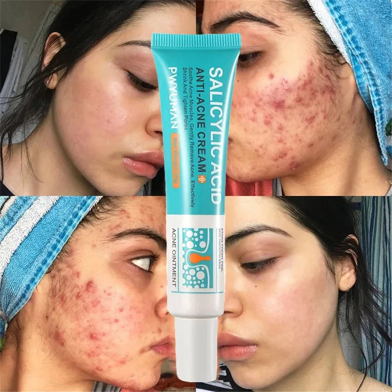 Salicylic Acid Acne Treatment Cream Shrink Pore Remove Blackheads Scars Acne Marks Spots Oil Control Whitening Korean Skin Care