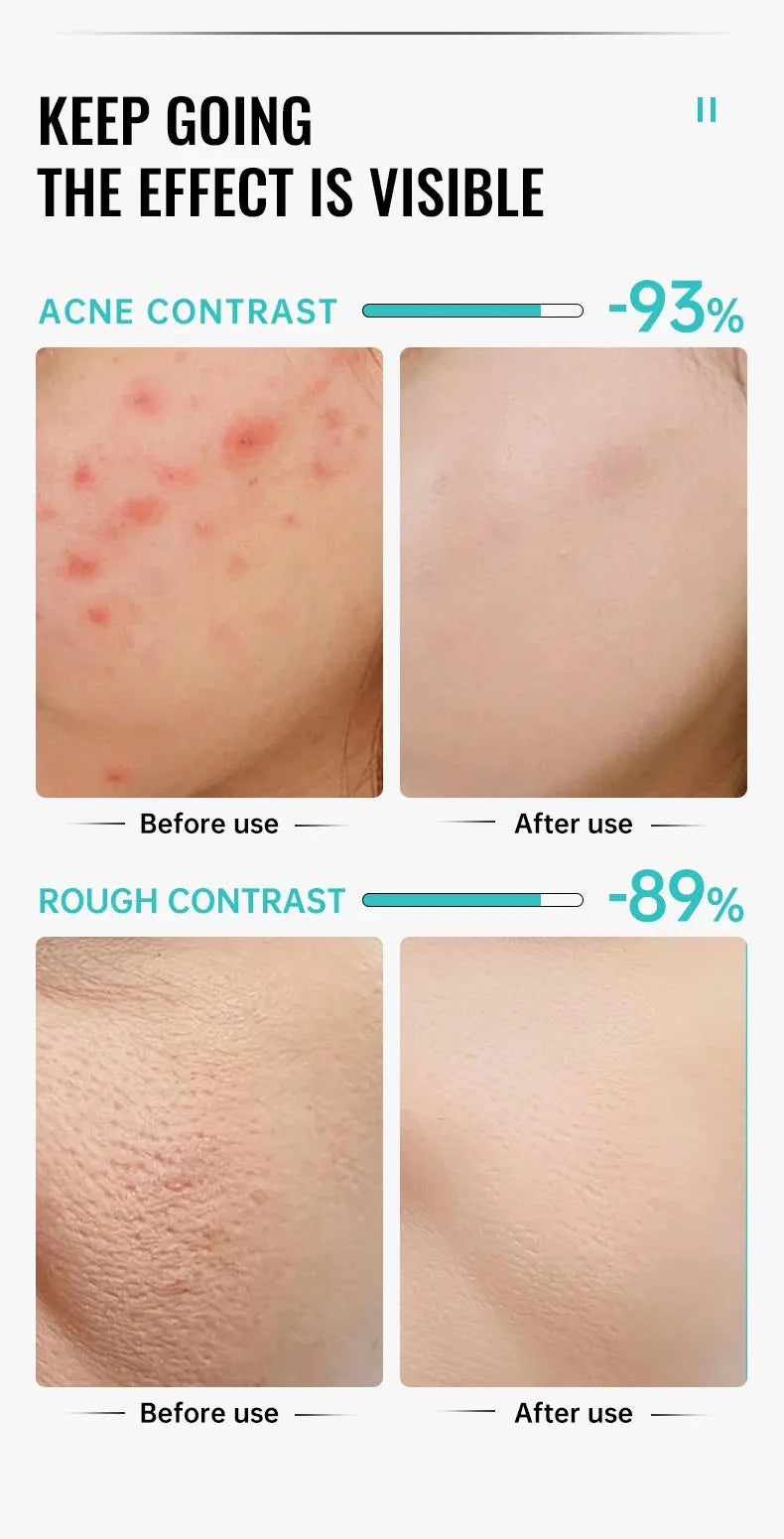 Salicylic Acid Acne Treatment Cream Shrink Pore Remove Blackheads Scars Acne Marks Spots Oil Control Whitening Korean Skin Care