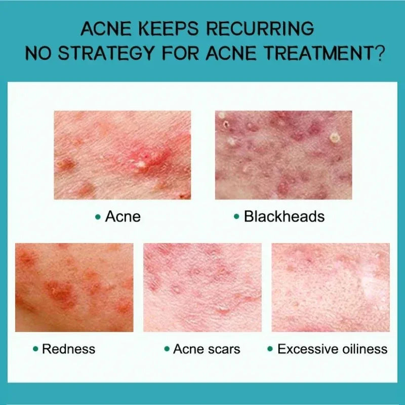Salicylic Acid Acne Treatment Cream Shrink Pore Remove Blackheads Scars Acne Marks Spots Oil Control Whitening Korean Skin Care