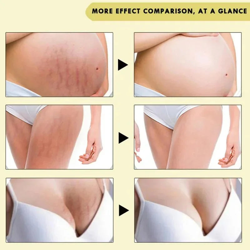 Stretch Mark Removal Oil Removes Postpartum Pregnant Women Scar Repair Obesity Stretch Mark Anti-Aging Firming Serum Skin Care