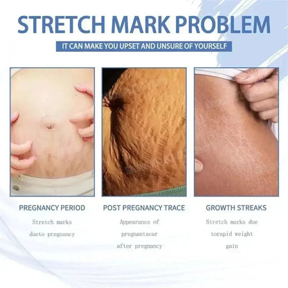 Stretch Marks Removal Cream Light Lines Postpartum Obesity Pregnancy Powerful Fast Absorption