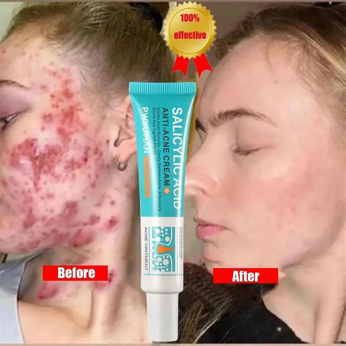Salicylic Acid Acne Treatment Cream Shrink Pore Remove Blackheads Scars Acne Marks Spots Oil Control Whitening Korean Skin Care