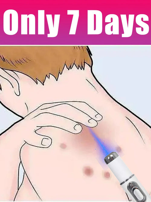 Generation-2 Laser Says Goodbye To all warts In 7 Days