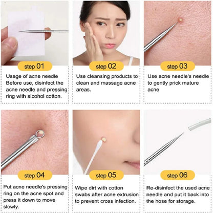 Dighealth 4PCS Stainless Steel Blackhead Remover Extraction Pimple Comedone Acne Extractor Whitehead Blemish Popper Kit