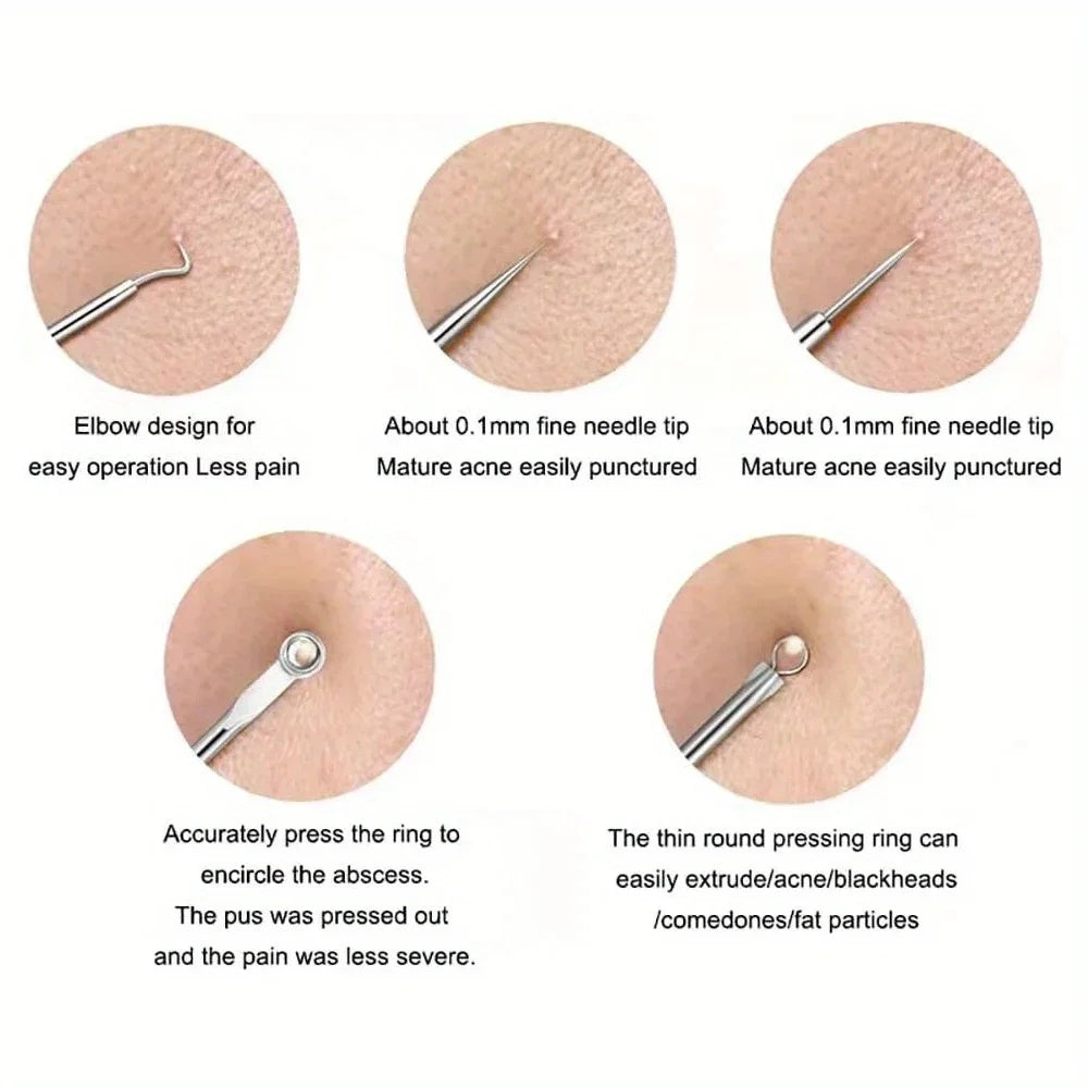 Blackhead Acne Pimple Blemish Extractor Remover Kit Stainless Steel Needles Remove Tools Face Skin Care Pore Cleaner 4pcs/bag