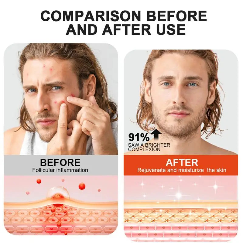 Body Acne Removal Cream Treatment Face Butt Back Acne Marks Smooth Repair Chicken Skin Cream Moisturizing Whitening Skin Care