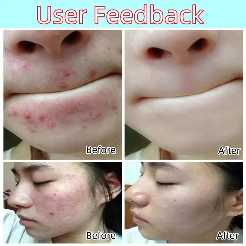 Salicylic Acid Acne Treatment Cream Shrink Pore Remove Blackheads Scars Acne Marks Spots Oil Control Whitening Korean Skin Care